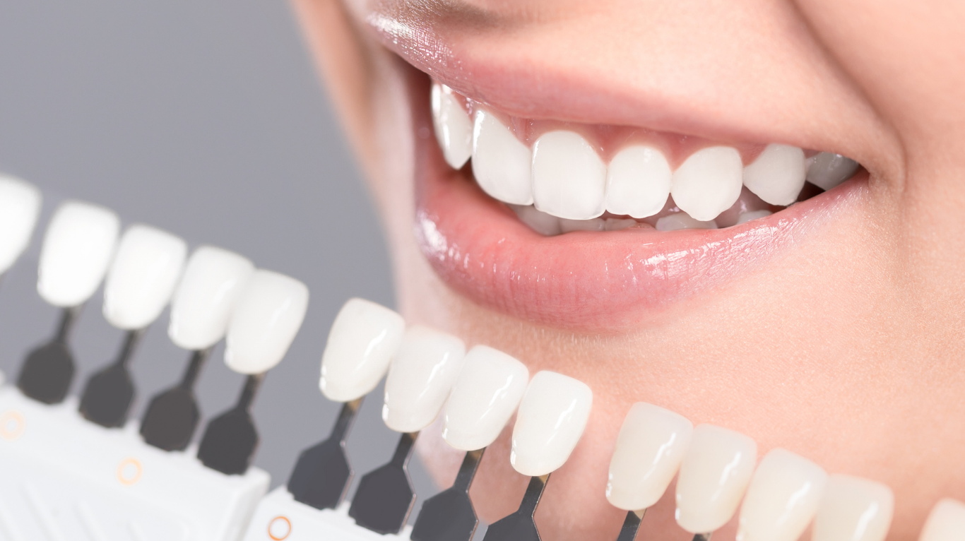 ブリーチホワイトニングのイメージ